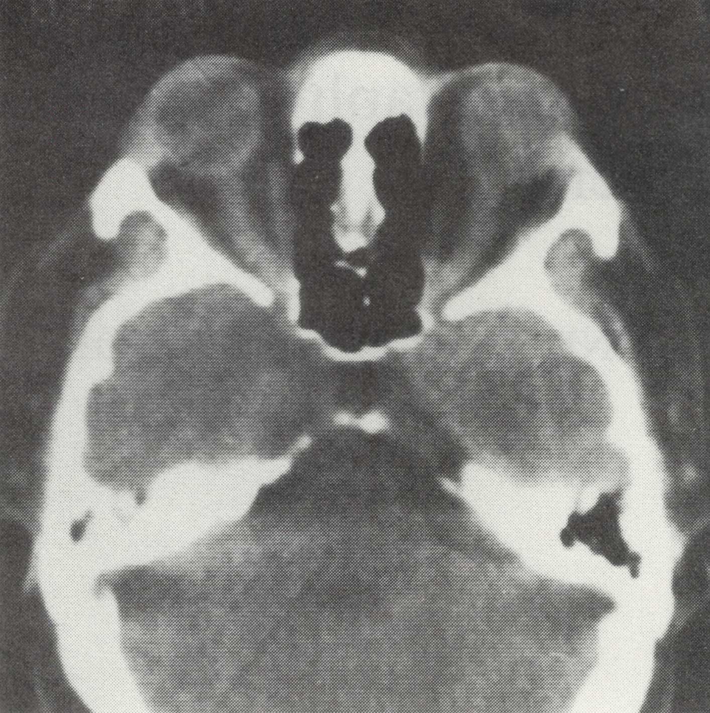 Axial CT-Scan showing narrow-diffuse enlargement of the optic nerves in patient 1