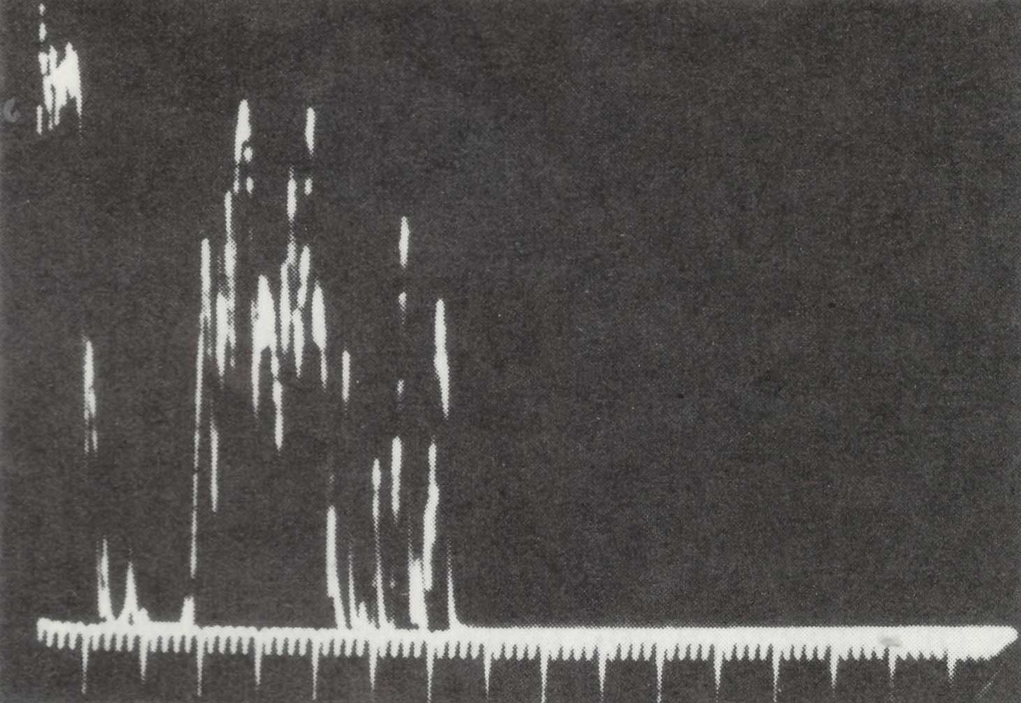 Standardized A-Scan echogram of thickened right optic nerve in patient 1