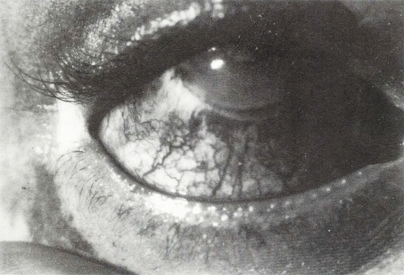 Characteristic ocular lesions of BD: iridocyclitis and episcleritis