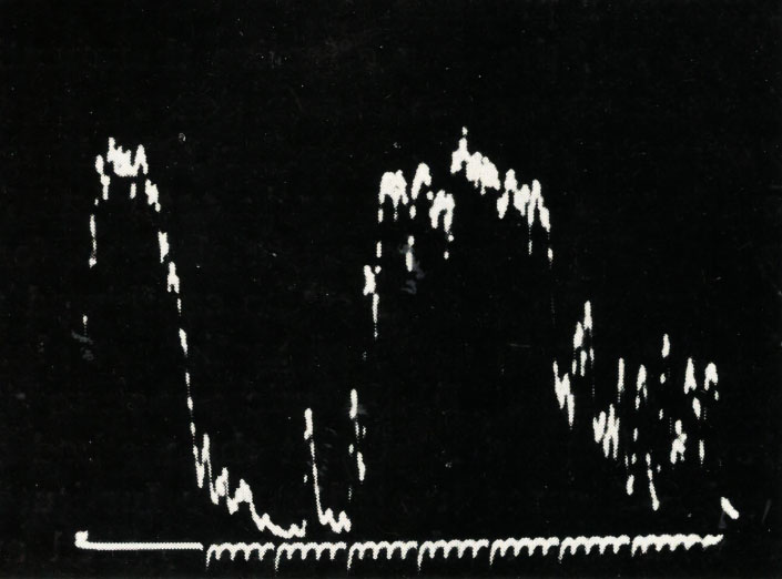 Ecography after paracentesis of the anterior chamber (low IOP)