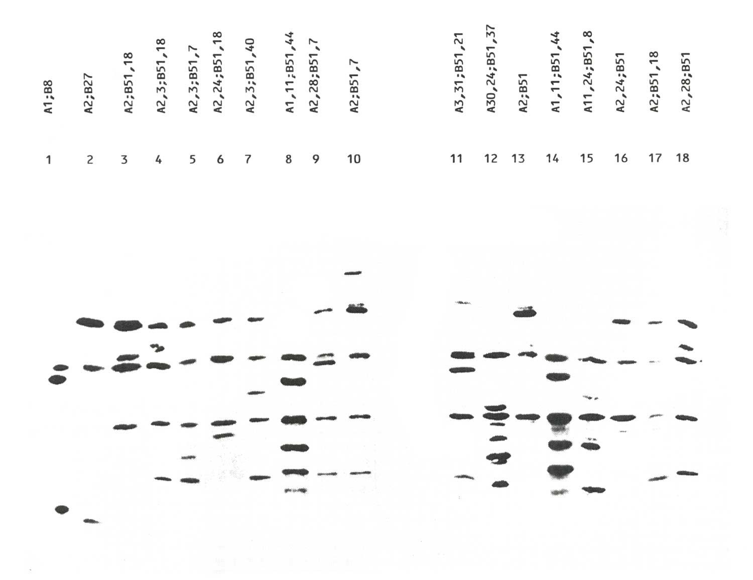 IEF migration patterns of HLA Class I antigens from healthy subjects and BO patients. Lanes 1-2 homozygous LCLs used as IEF markers; lanes 3-10 healthy subjects; lane 11-18 BO patients. HLA Class I typing is showed on the top of each lane
