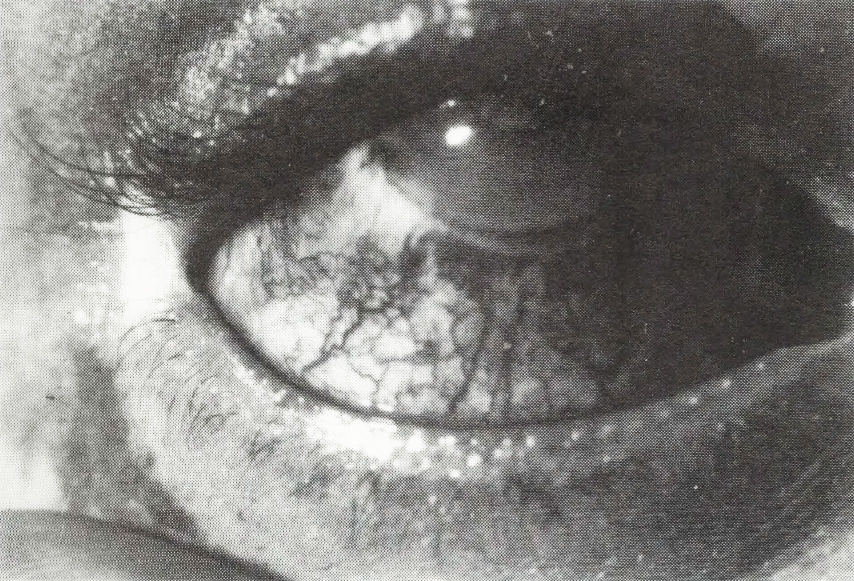 Characteristic ocular lesions of BD: iridocyclitis and episcleritis