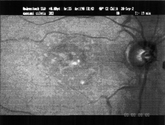 Posterior pole view of SM's right eye