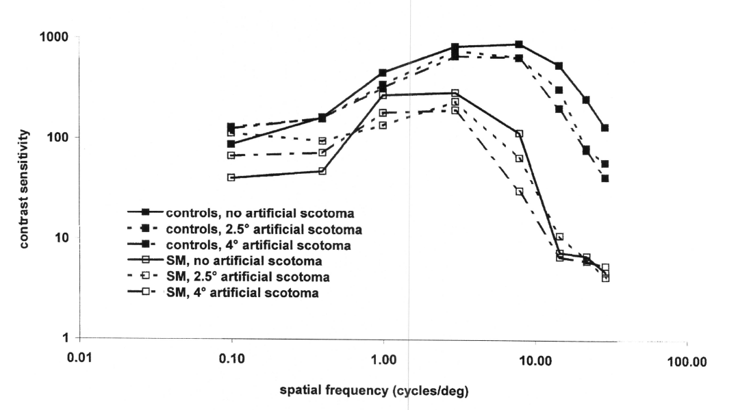 Contrast sensitivity as a function of spatial frequency in both SM and controls under three conditions (normal viewing and viewing with artificial scotoma of either 2.5 or 4 deg diameter). Cortical plasticity overcomes impaired vision