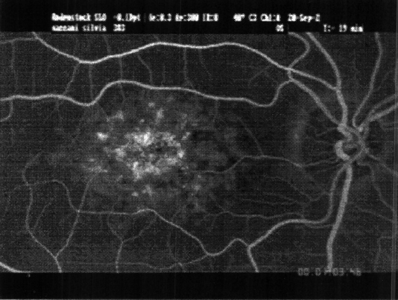 Fluorescein angiogram in late venous phase shows a central area of hyperfluorescence caused by atrophic changes of the retinal pigmented epithelium (RPE)