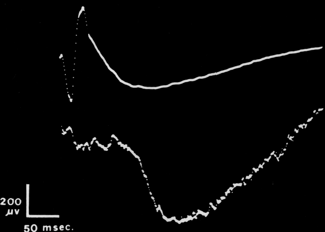 Above: ERG of the stimulated eye. Below: Electric consensual response of the non-stimulated eye
